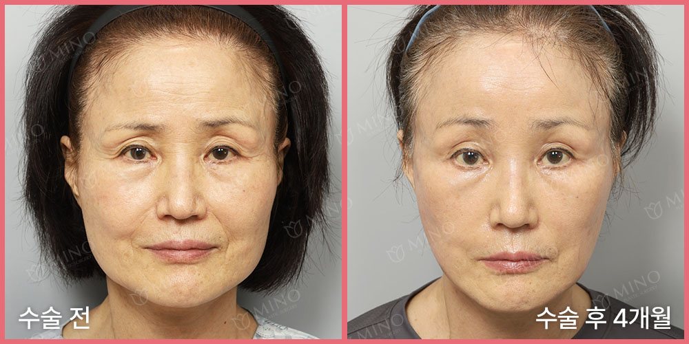 안면거상 재수술 + 목거상 + 내시경 이마거상 + 눈위꺼짐필러 + 팔자지방이식 — 정면 수술 전 / 수술 후 4개월