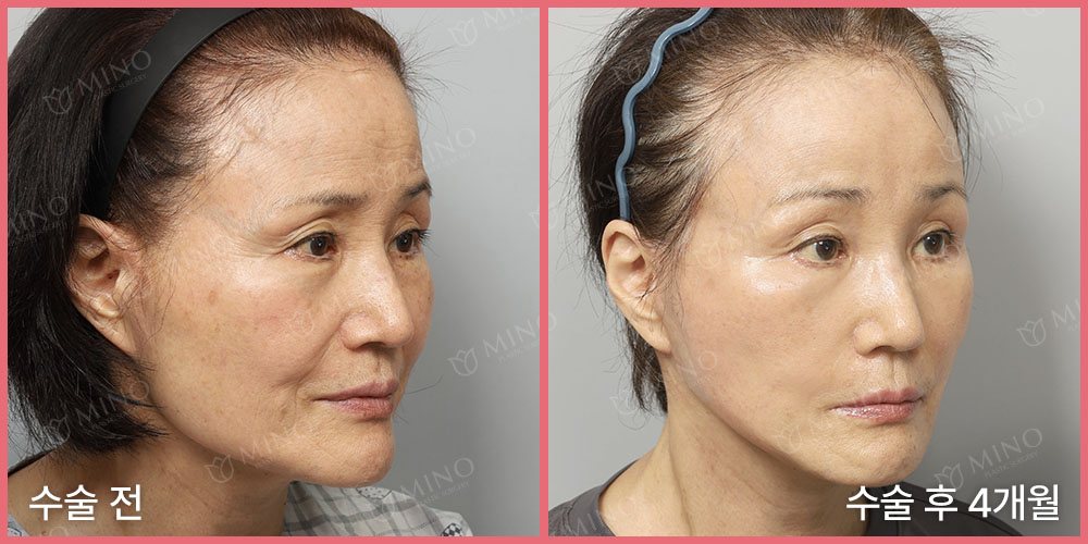 안면거상 재수술 + 목거상 + 내시경 이마거상 + 눈위꺼짐필러 + 팔자지방이식 — 45도 수술 전 / 수술 후 4개월