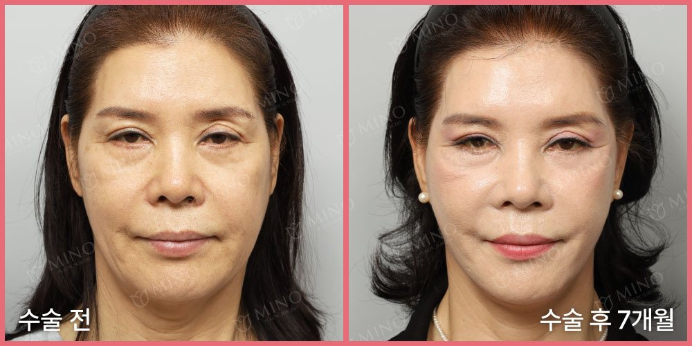 안면거상 + 목거상 + 인디언리프팅(하안검플러스) 재수술 — 정면 수술 전 / 수술 후 7개월