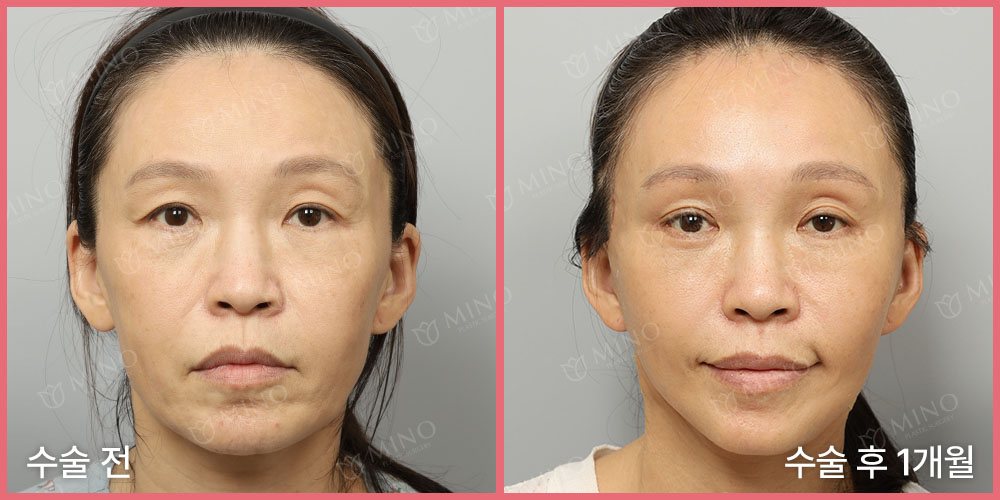 안면거상 + 목거상 + 내시경 이마거상 + 눈썹하거상 + 인디언리프팅(하안검플러스) 재수술 + 팔자지방이식 + 눈위꺼짐필러 1cc — 정면 수술 전 / 수술 후 1개월