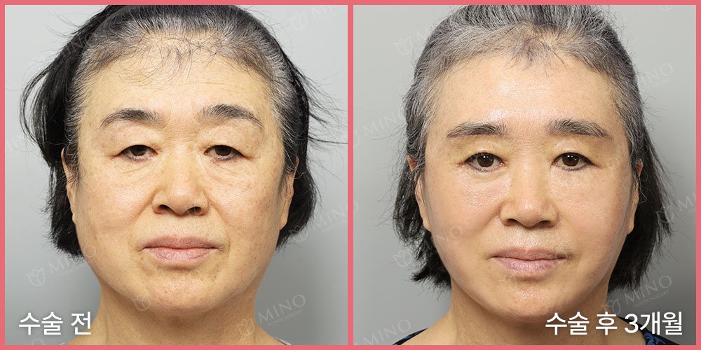 안면거상 + 목거상 + 내시경 이마거상 + 상안검 + 인디언리프팅(하안검플러스) + 지방이식(팔자) — 정면 수술 전 / 수술 후 3개월