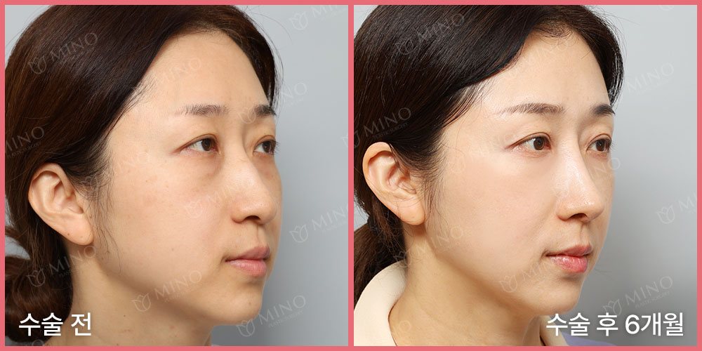 무보형물 코성형 — 45도 수술 전 / 수술 후 6개월