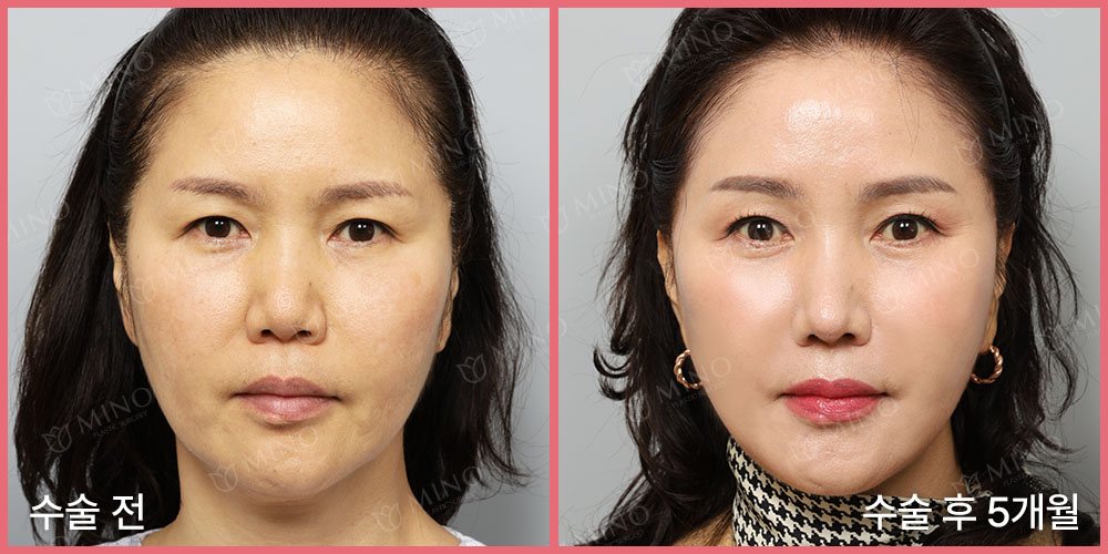 내시경 이마거상술 + 인디언 리프팅(하안검플러스) + 안면, 목거상술 + 무보형물 코성형 — 정면 수술 전 / 수술 후 5개월