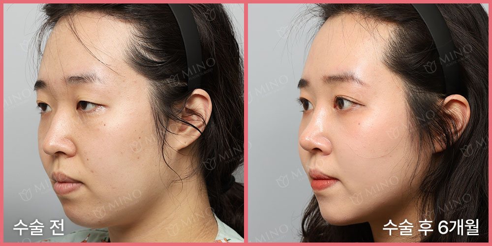 무보형물 코성형 + 절개 쌍꺼풀수술 — 45도 수술 전 / 수술 후 6개월