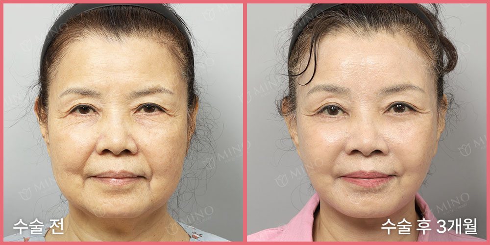 안면거상 + 목거상 + 내시경 이마거상 + 인디언리프팅(하안검플러스) 재수술 + 이중턱근육묶기 + 침샘제거 + 팔자지방이식 — 정면 수술 전 / 수술 후 3개월