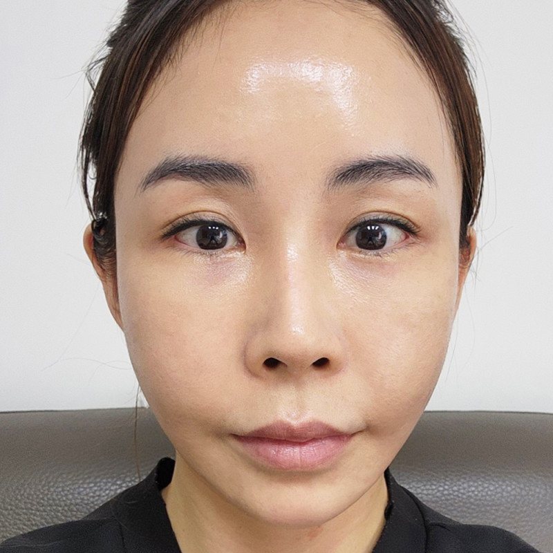 리프팅 셀카 후기 8 — 올림머리 여성 정면 셀카