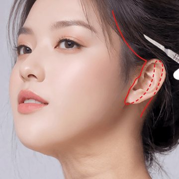 STEP 01 — 여성 모델 옆얼굴, 귀 앞·관자 절개 디자인 빨간 선과 메스