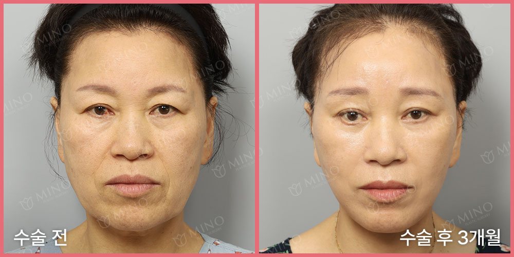 안면거상 + 목거상 + 내시경 이마거상 + 눈썹하거상 + 인디언리프팅(하안검플러스) 재수술 + 팔자지방이식,자갈턱BTX — 정면 수술 전 / 수술 후 3개월(사진 속 글 '수술 전'·'수술 후 3개월', 분홍 테두리, 'MINO' 워터마크)