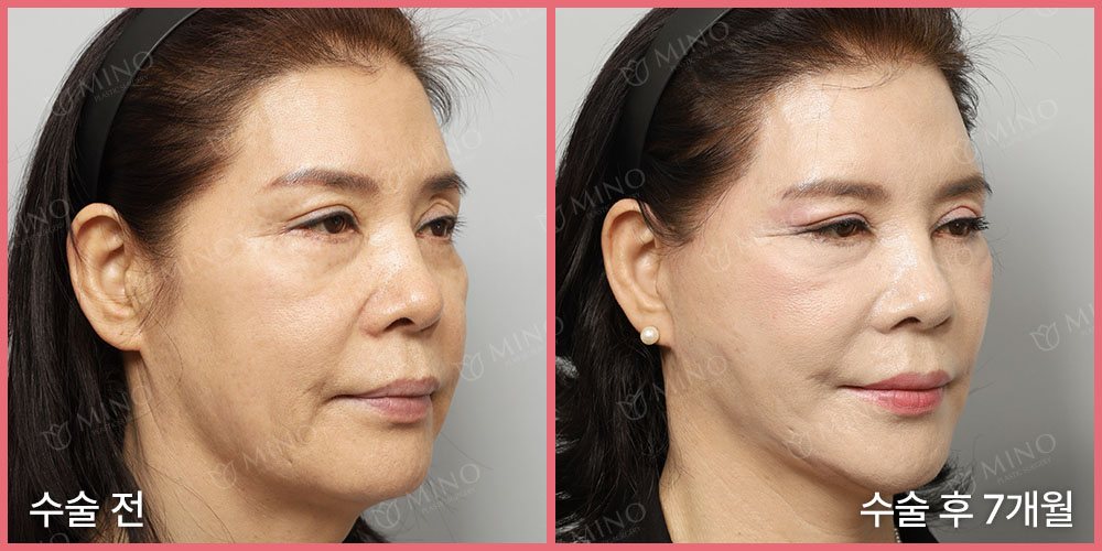 안면거상 + 목거상 + 인디언리프팅(하안검플러스) 재수술 — 45도 수술 전 / 수술 후 7개월(사진 속 글 '수술 전'·'수술 후 7개월', 분홍 테두리, 'MINO' 워터마크)