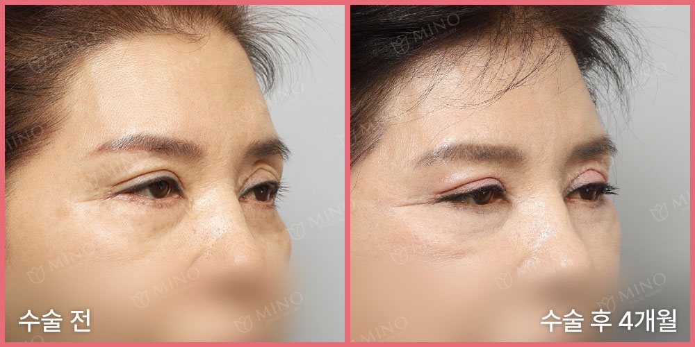 리프팅하안검 재수술 — 45도 수술 전 / 수술 후 4개월(사진 속 글 '수술 전'·'수술 후 4개월', 분홍 테두리, 'MINO' 워터마크)