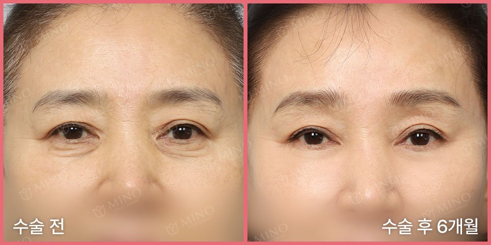 리프팅하안검+내시경이마거상 — 정면 수술 전 / 수술 후 6개월(사진 속 글 '수술 전'·'수술 후 6개월', 분홍 테두리, 'MINO' 워터마크)