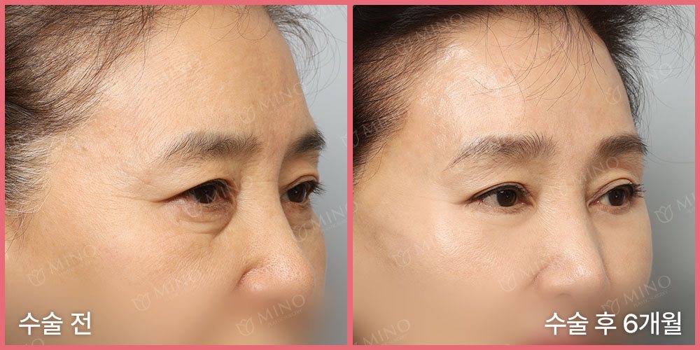 리프팅하안검+내시경이마거상 — 45도 수술 전 / 수술 후 6개월(사진 속 글 '수술 전'·'수술 후 6개월', 분홍 테두리, 'MINO' 워터마크)