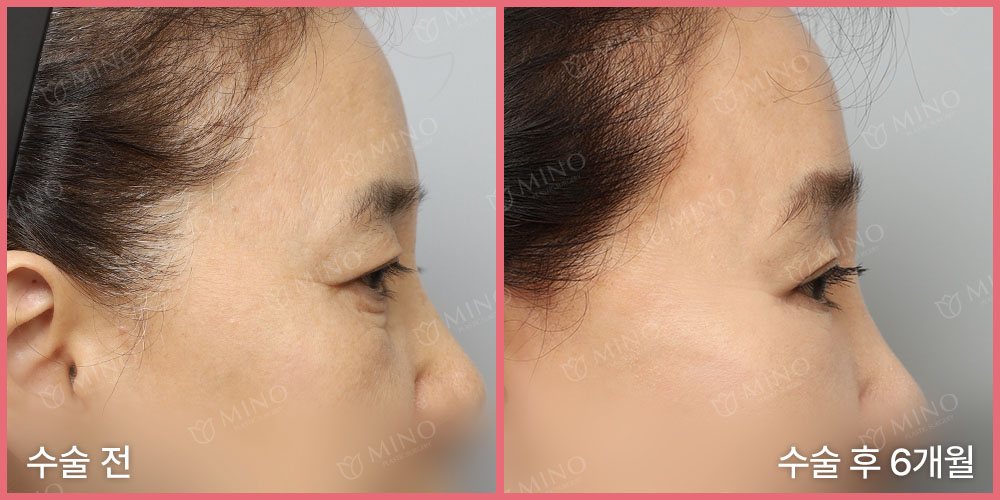 리프팅하안검+내시경이마거상 — 측면 수술 전 / 수술 후 6개월(사진 속 글 '수술 전'·'수술 후 6개월', 분홍 테두리, 'MINO' 워터마크)