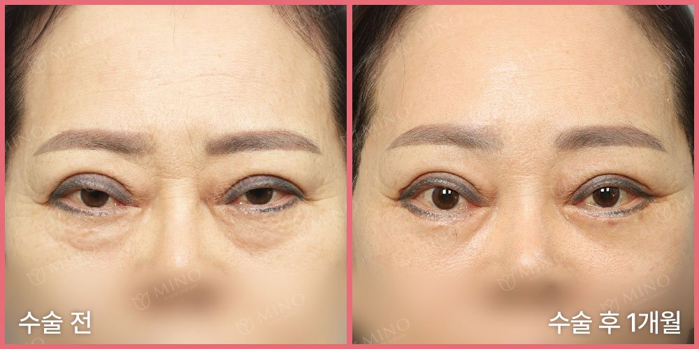 리프팅하안검+내시경이마거상 — 정면 수술 전 / 수술 후 1개월(사진 속 글 '수술 전'·'수술 후 1개월', 분홍 테두리, 'MINO' 워터마크)