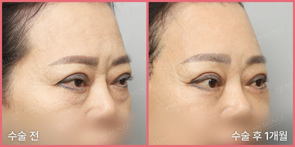 리프팅하안검+내시경이마거상 — 45도 수술 전 / 수술 후 1개월(사진 속 글 '수술 전'·'수술 후 1개월', 분홍 테두리, 'MINO' 워터마크)