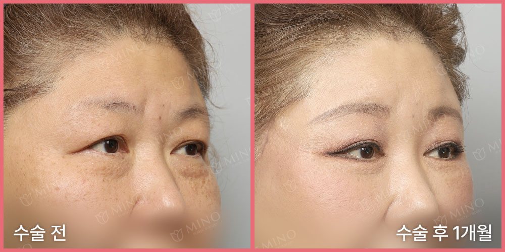 리프팅하안검+내시경이마거상+눈썹하거상 — 45도 수술 전 / 수술 후 1개월(사진 속 글 '수술 전'·'수술 후 1개월', 분홍 테두리, 'MINO' 워터마크)