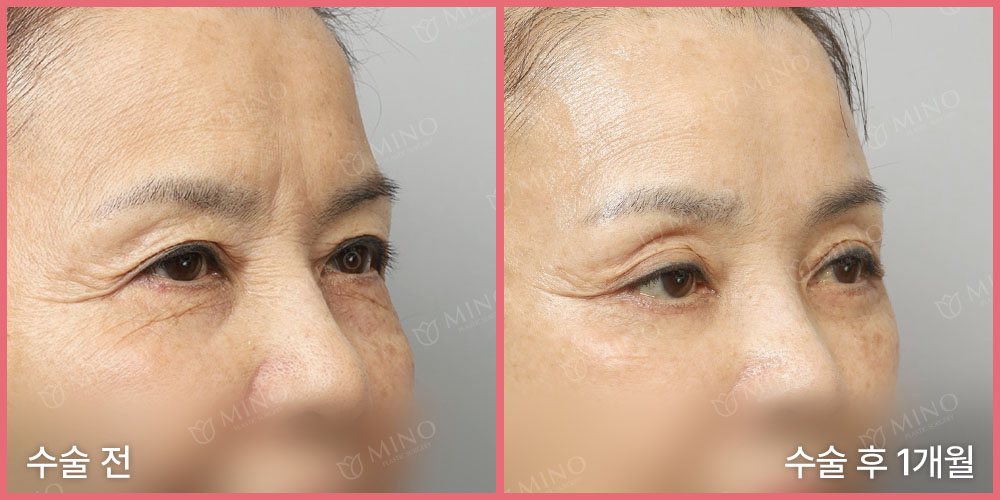 리프팅하안검 재수술+내시경이마거상 — 45도 수술 전 / 수술 후 1개월(사진 속 글 '수술 전'·'수술 후 1개월', 분홍 테두리, 'MINO' 워터마크)