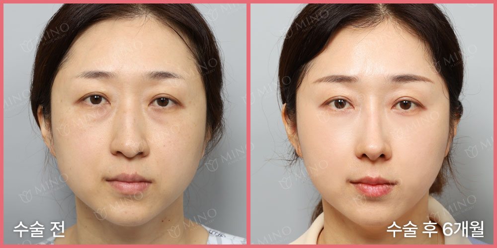 무보형물 코성형 — 정면 수술 전 / 수술 후 6개월(사진 속 글 '수술 전'·'수술 후 6개월', 분홍 테두리, 'MINO' 워터마크)
