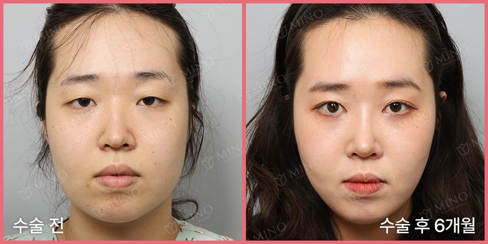 무보형물 코성형 + 절개 쌍꺼풀수술 — 정면 수술 전 / 수술 후 6개월(사진 속 글 '수술 전'·'수술 후 6개월', 분홍 테두리, 'MINO' 워터마크)