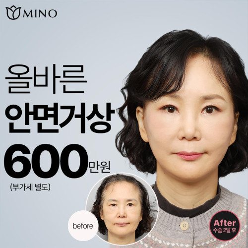 MINO 올바른 안면거상 600만원 (부가세 별도) before After 수술 2달 후