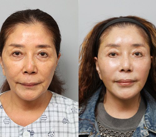 수술일지 썸네일 — 안면거상재수술 등 전(왼쪽)·후(오른쪽) 얼굴 정면