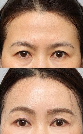 수술일지 썸네일 — 내시경 이마거상술 전(위)·후(아래) 눈·이마 부분