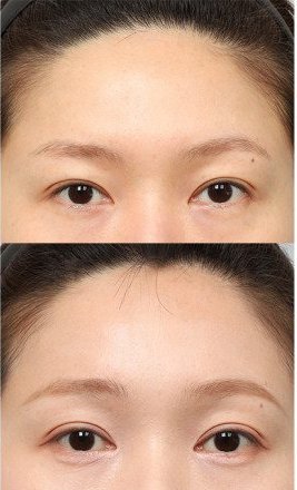 수술일지 썸네일 — 내시경 이마거상 전(위)·후(아래) 눈·이마 부분
