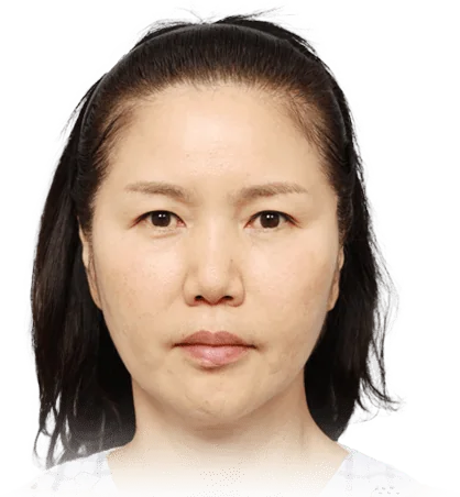 내시경 이마거상술 수술 전(Before) 정면 — 머리띠를 한 중년 여성